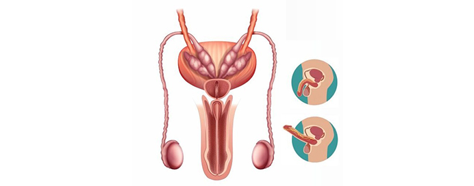 Low Testosterone & Erectile Dysfunction